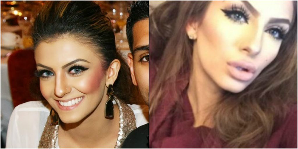 Faryal Makhdoom's shocking pictures of Before & After Cosmetic Surgery