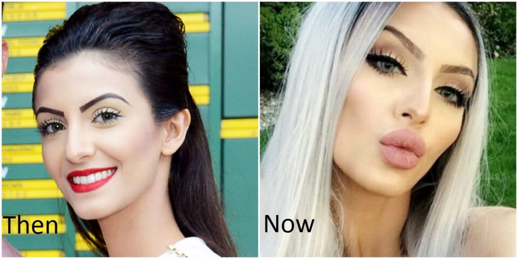 Faryal Makhdoom's shocking pictures of Before & After Cosmetic Surgery