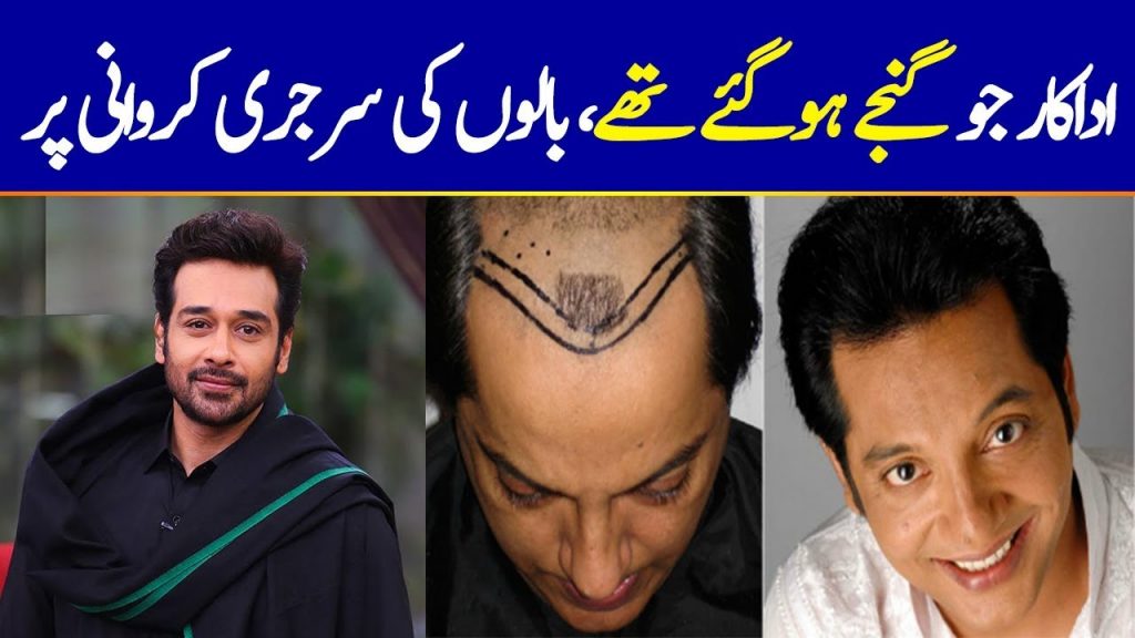 Pakistani Celebrities Who Got Hair Transplant
