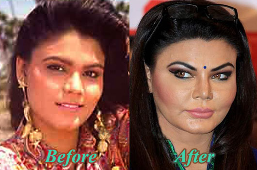 Bollywood Actresses Transformation through Facial Surgeries - 2020