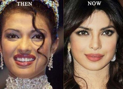 Bollywood Actresses Transformation through Facial Surgeries - 2020