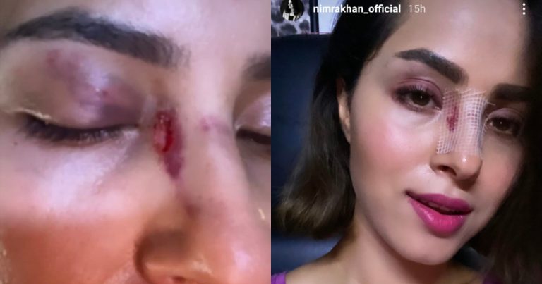 Actress Nimra Khan’s Nose Got Injured Badly