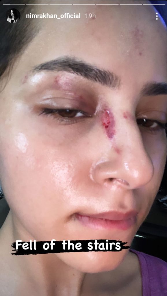 Actress Nimra Khan's Nose Got Injured Badly
