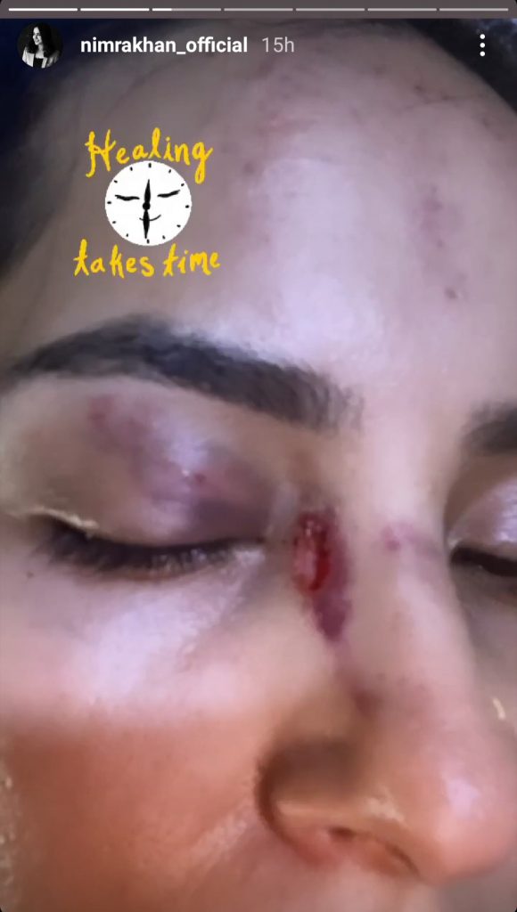 Actress Nimra Khan's Nose Got Injured Badly