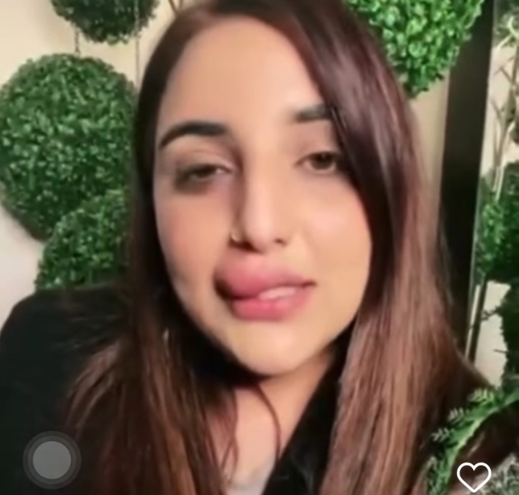 Hareem Shah’s Lip Filler Procedure Gone Wrong