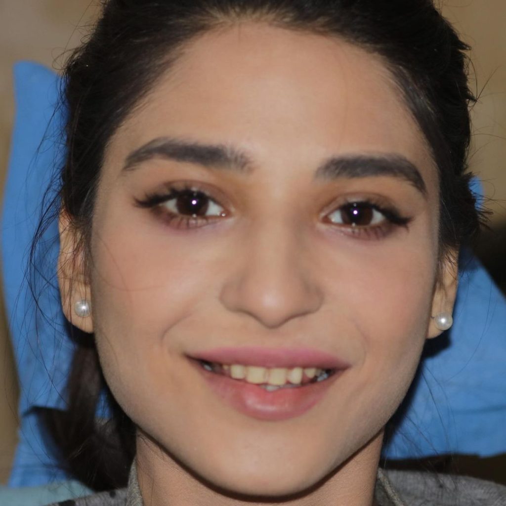 Actress Ramsha Khan Smile Before & After Fixing Teeth