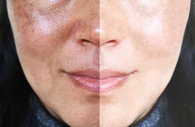 Natasha Lakhani Shares DIY Face Mask For Hyperpigmentation
