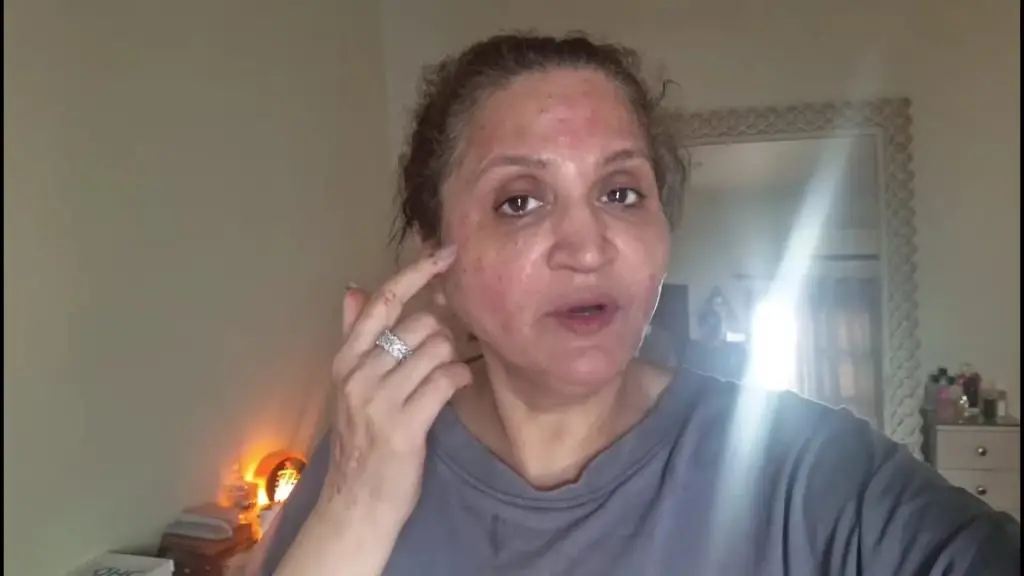 Asma Abbas’s Skin Procedure Goes Wrong