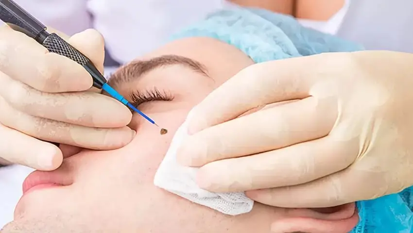 Asma Abbas’s Skin Procedure Goes Wrong