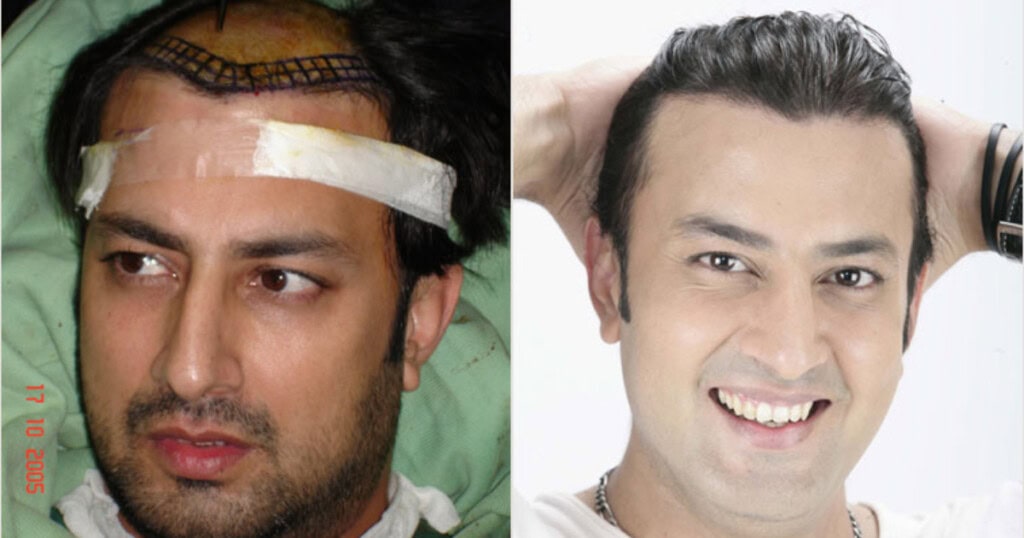 Syed Jibran’s Take On Actors Using Ozempic & Hair Patches