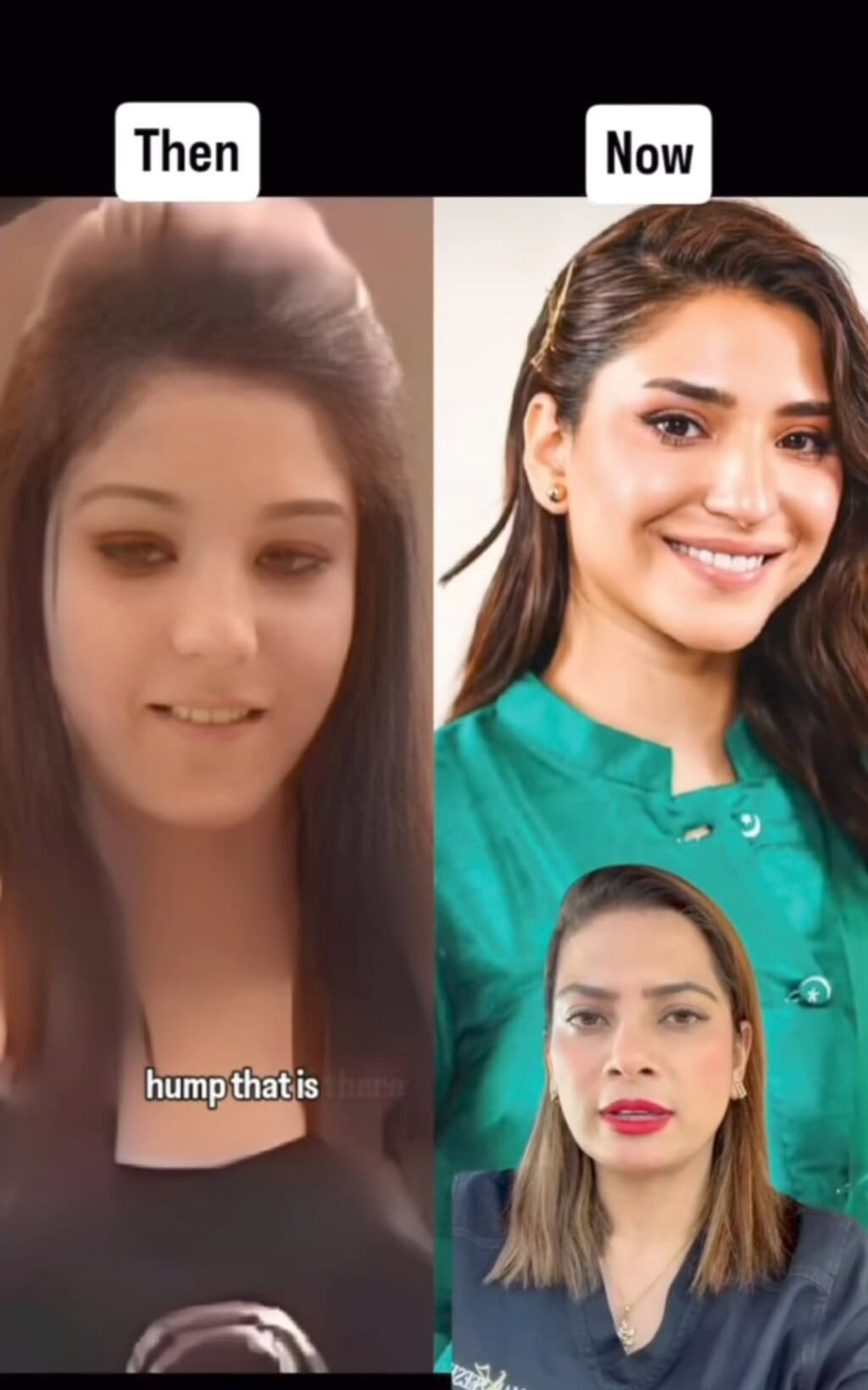 Ramsha Khan Cosmetic Surgeries Explained by Dermatologist