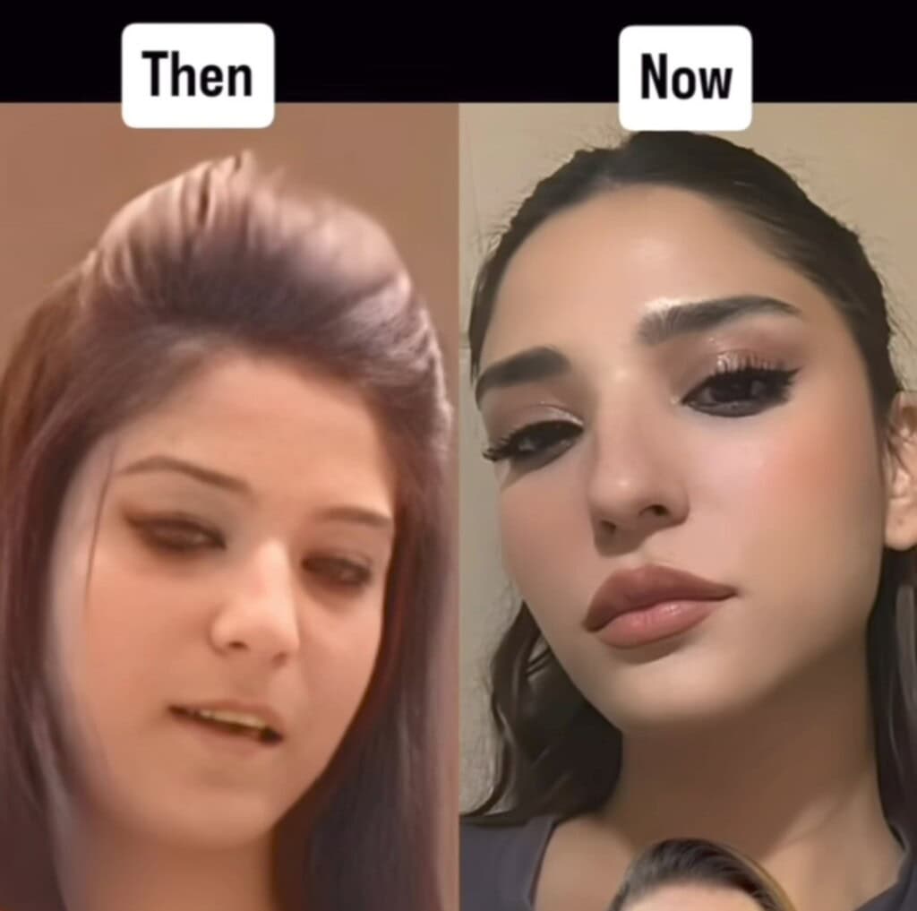 Ramsha Khan Cosmetic Surgeries Explained by Dermatologist