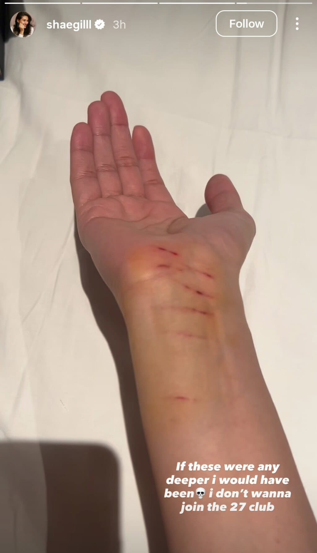 Shae Gill Got Injured While Performing in Islamabad
