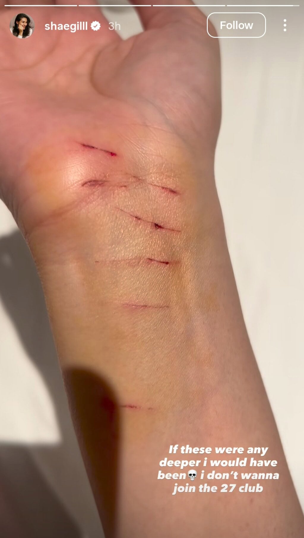 Shae Gill Got Injured While Performing in Islamabad