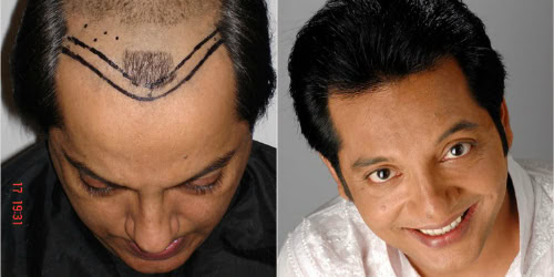 Affan Waheed Shares Thoughts On Cosmetic Surgery