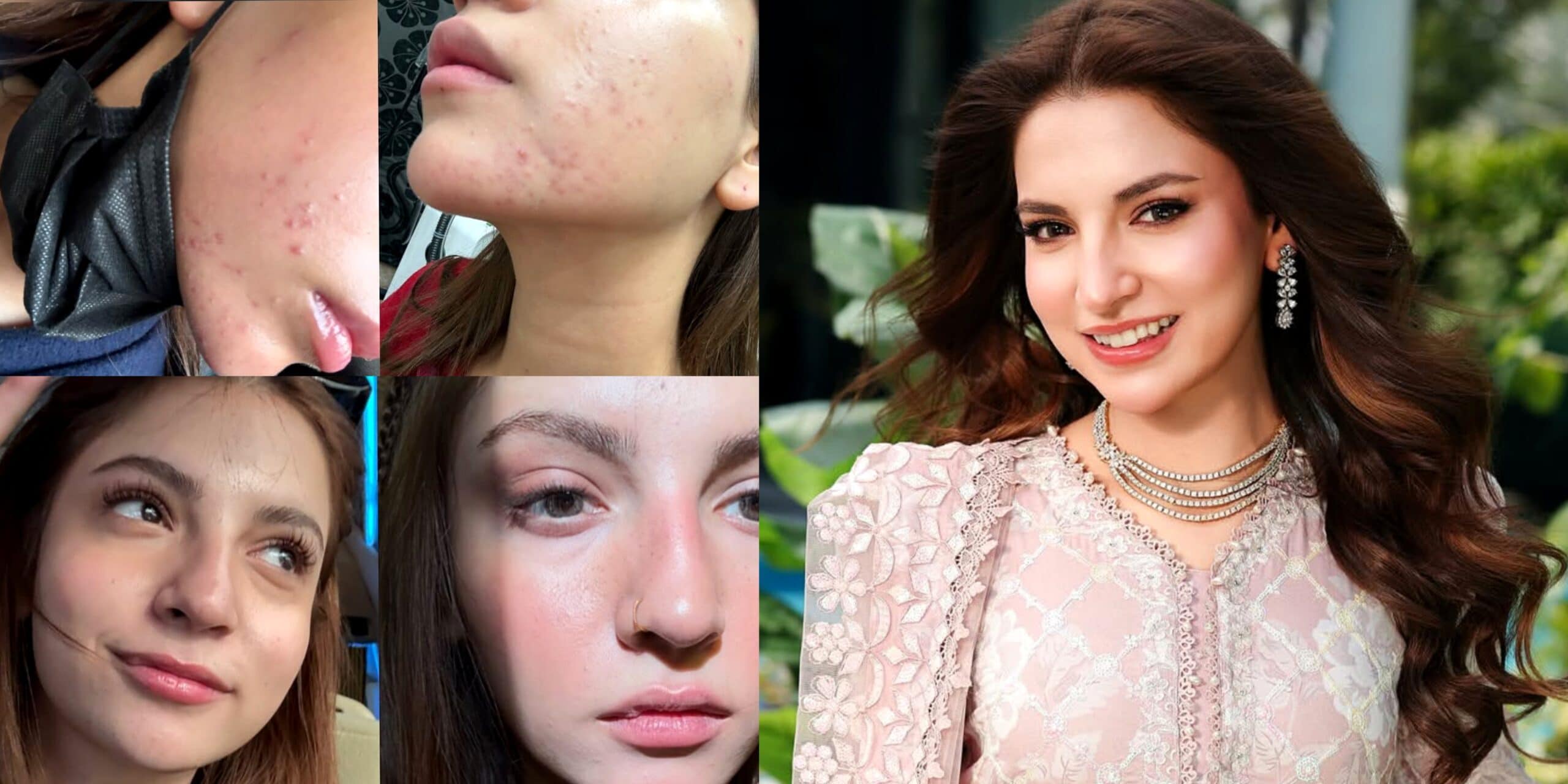 Dananeer Mobeen’s Honest Take on Skin Imperfections Wins Praise
