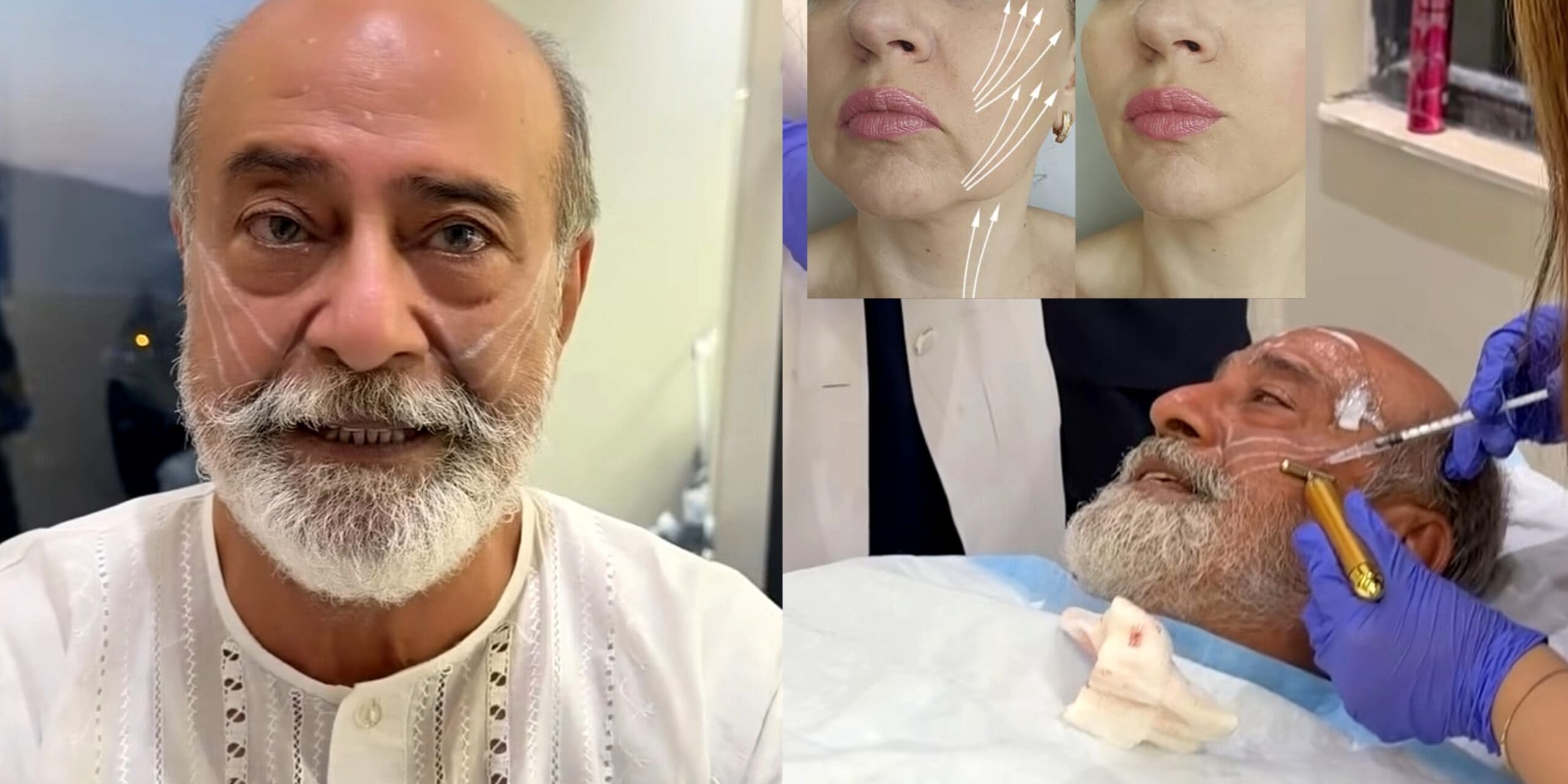 Mohammad Ahmed Undergoes Face Lift Procedure