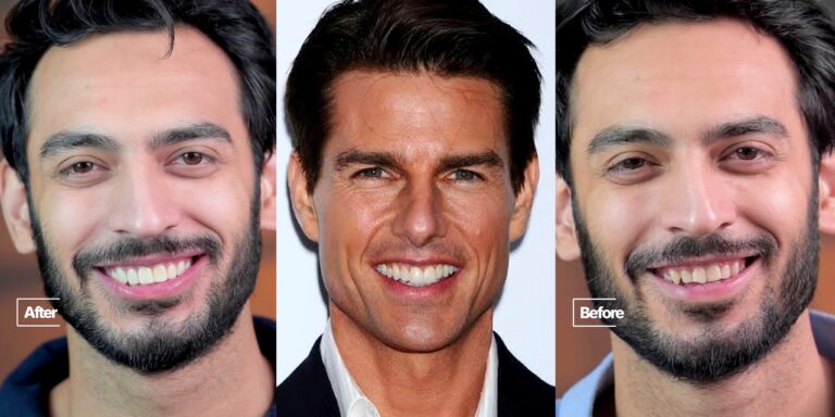 Saif Ali Khan Hollywood Smile Makeover Gets Fans’ Attention