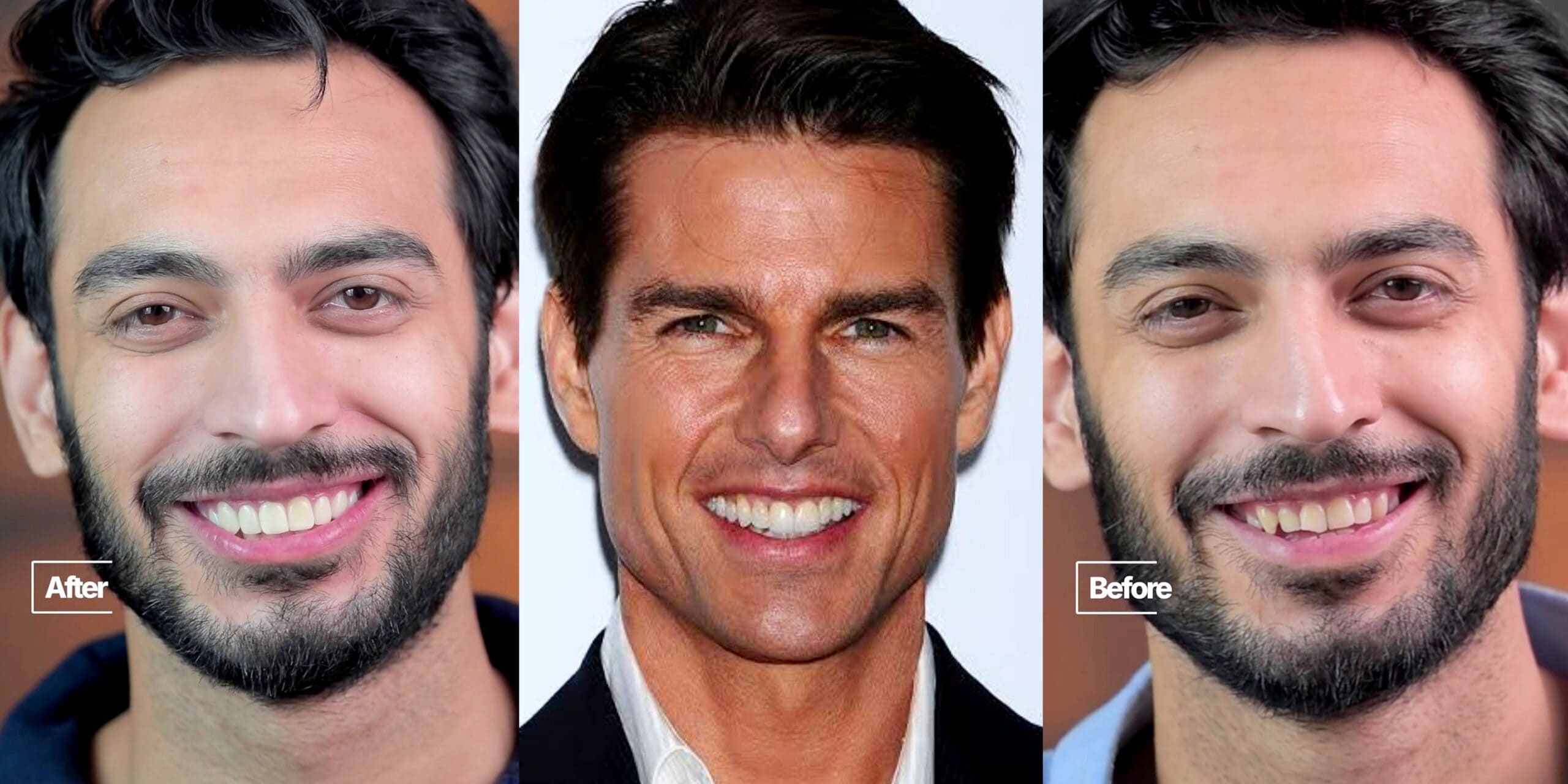 Saif Ali Khan Hollywood Smile Makeover Gets Fans’ Attention