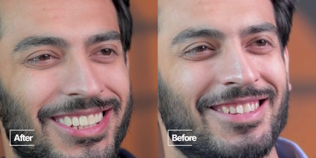 Saif Ali Khan Hollywood Smile Makeover Gets Fans' Attention Saif Ali Khan Hollywood Smile Makeover Gets Fans’ Attention