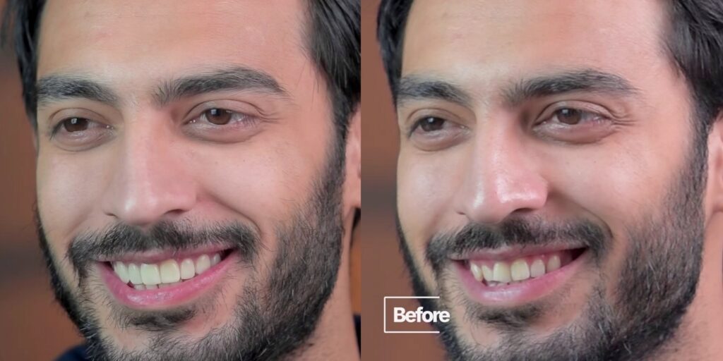 Saif Ali Khan Hollywood Smile Makeover Gets Fans' Attention Saif Ali Khan Hollywood Smile Makeover Gets Fans’ Attention