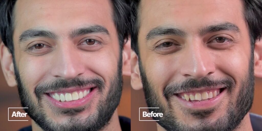 Saif Ali Khan Hollywood Smile Makeover Gets Fans' Attention Saif Ali Khan Hollywood Smile Makeover Gets Fans’ Attention